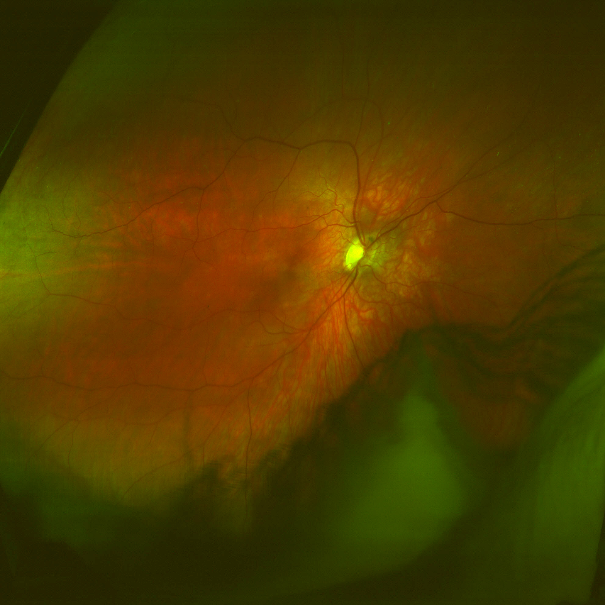 normal retina exam feathre macula