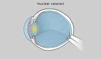 3 Common Types of Cataracts | Eyegotcha