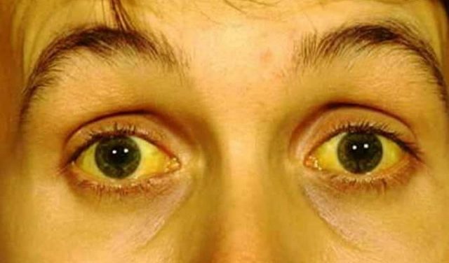 Yellowing of the Eyes: What Does it Mean?